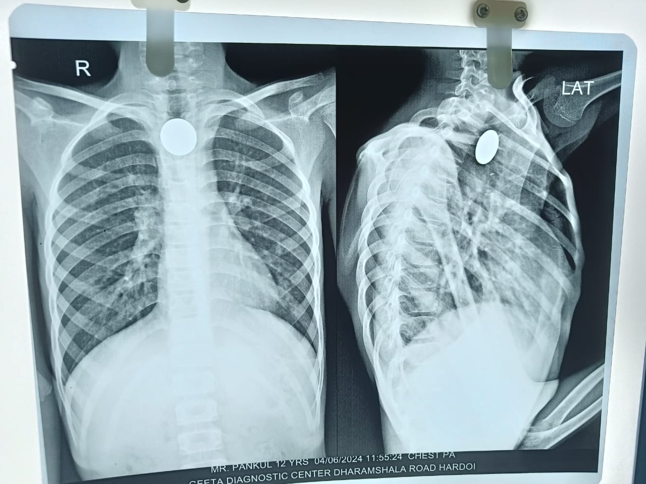 हरदोई के मेडिकल कालेज में डॉक्टर का कमाल; बच्चे के गले में 7 साल से फंसा सिक्का सर्जरी कर निकाला, पीलिया से पीड़ित बच्चा डॉक्टर को दिखाने पहुंचा था